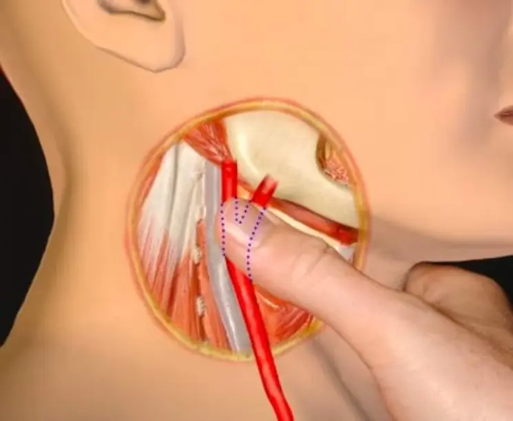 ảnh giải phẫu choking